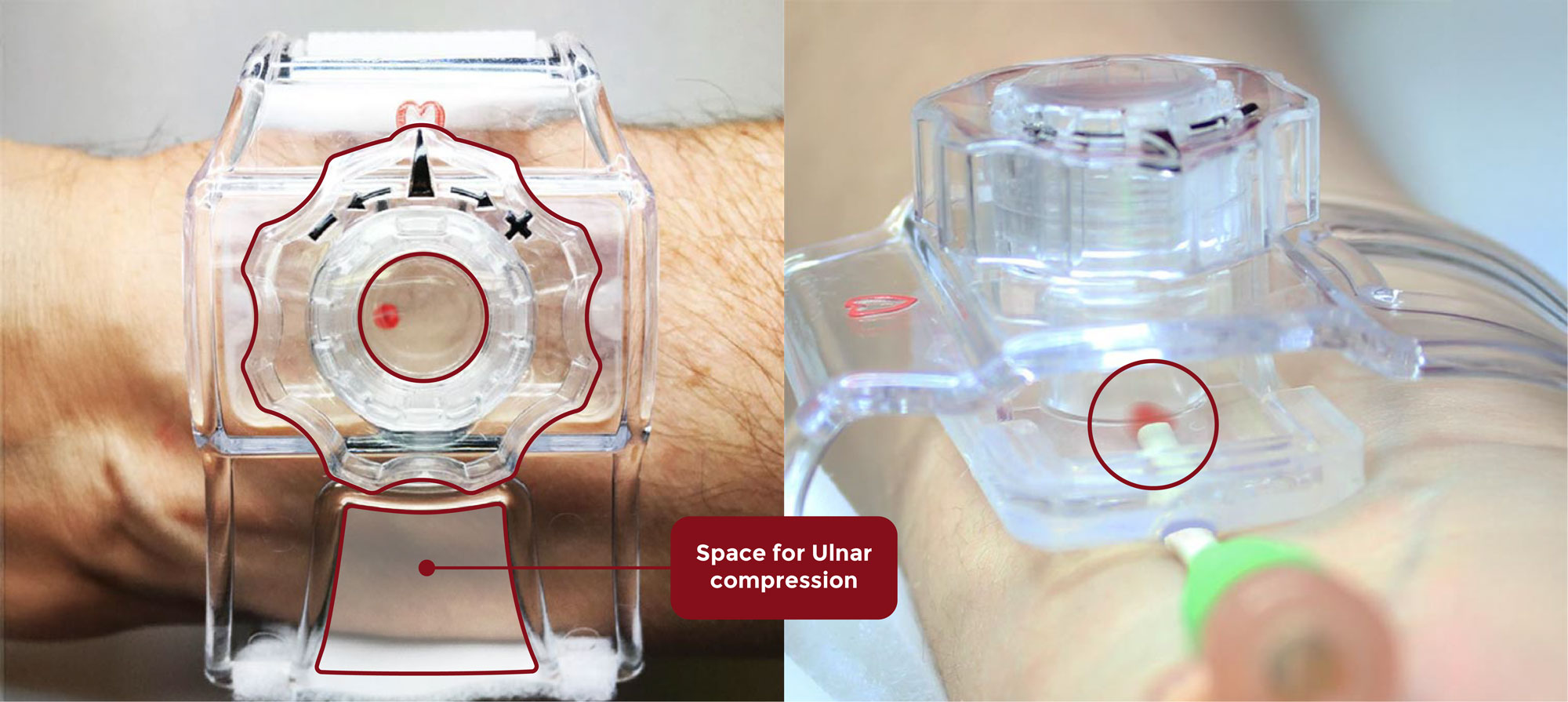 Space for Ulnar compression